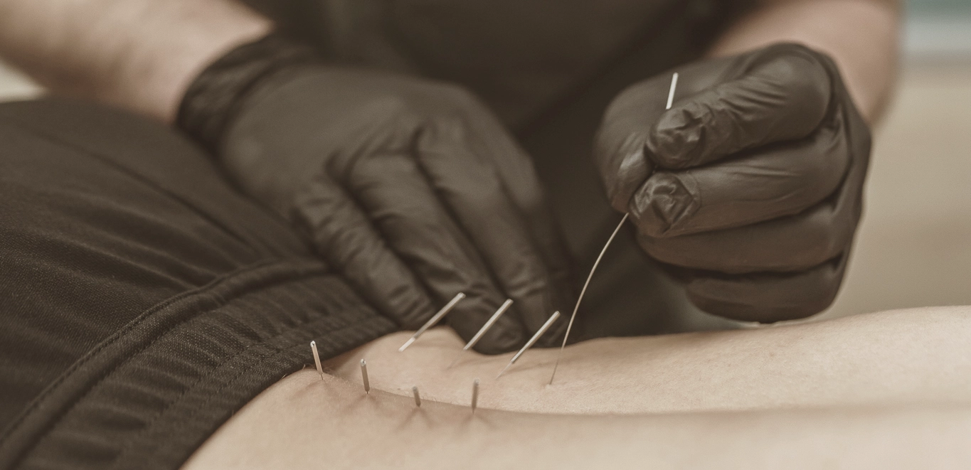 dry needling Aberdeen